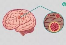 बात भूल जाना एक आम स्थिति है। लेकिन यह डिमेंशिया जैसी गंभीर समस्या की शुरुआत हो सकती है।