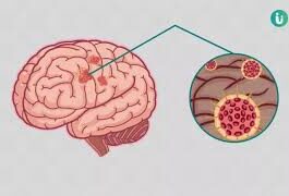 बात भूल जाना एक आम स्थिति है। लेकिन यह डिमेंशिया जैसी गंभीर समस्या की शुरुआत हो सकती है।