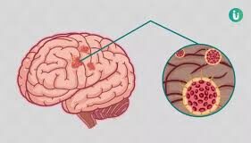 बात भूल जाना एक आम स्थिति है। लेकिन यह डिमेंशिया जैसी गंभीर समस्या की शुरुआत हो सकती है।