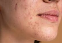 चेहरे पर पिंपल्स होने की समस्या बहुत आम होती है। मगर क्या आप जानते हैं कि चेहरे पर मुंहासे और फोड़े-फुंसियों की समस्या किन कारणों से होती है?