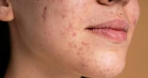 चेहरे पर पिंपल्स होने की समस्या बहुत आम होती है। मगर क्या आप जानते हैं कि चेहरे पर मुंहासे और फोड़े-फुंसियों की समस्या किन कारणों से होती है?