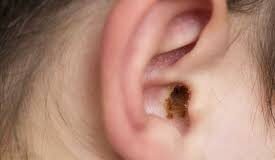 How to remove Earwax: तीली या तेल न डालें, कान के मैल के लिए ENT डॉ. ने बताए 3 तरीके, खुद निकलेगी पीली गंदगी कान में मैल एक नेचुरल और सेल्फ-क्लीनिंग पदार्थ होता है, जो कान को धूल और बैक्टीरिया से बचाता है, लेकिन ज्यादा जमा होने पर दर्द, भारीपन और सुनने में दिक्कत हो सकती है।