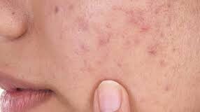 चेहरे पर दिखने वाले फोड़े-फुंसियों को कम करने के लिए आपको चेहरे पर केमिकल्स की लेयरिंग नहीं करनी पड़ेगी।