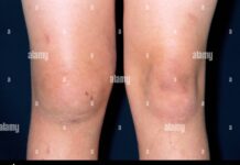 ठंड के मौसम में कुछ लोगों को खून की नसों में एलर्जी जैसी गंभीर समस्या हो सकती है, जिसमें नसें सिकुड़कर ब्लड फ्लो कम कर देती हैं।