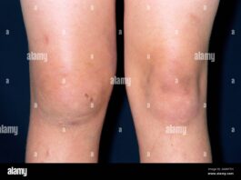 ठंड के मौसम में कुछ लोगों को खून की नसों में एलर्जी जैसी गंभीर समस्या हो सकती है, जिसमें नसें सिकुड़कर ब्लड फ्लो कम कर देती हैं।