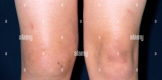 ठंड के मौसम में कुछ लोगों को खून की नसों में एलर्जी जैसी गंभीर समस्या हो सकती है, जिसमें नसें सिकुड़कर ब्लड फ्लो कम कर देती हैं।