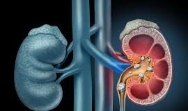 पाषाणभेद समेत 5 आयुर्वेदिक जड़ी-बूटियां किडनी स्टोन के दर्द से राहत देती हैं किडनी स्टोन का दर्द असहनीय होता है, फिर भी इसका जिक्र कम होता है।