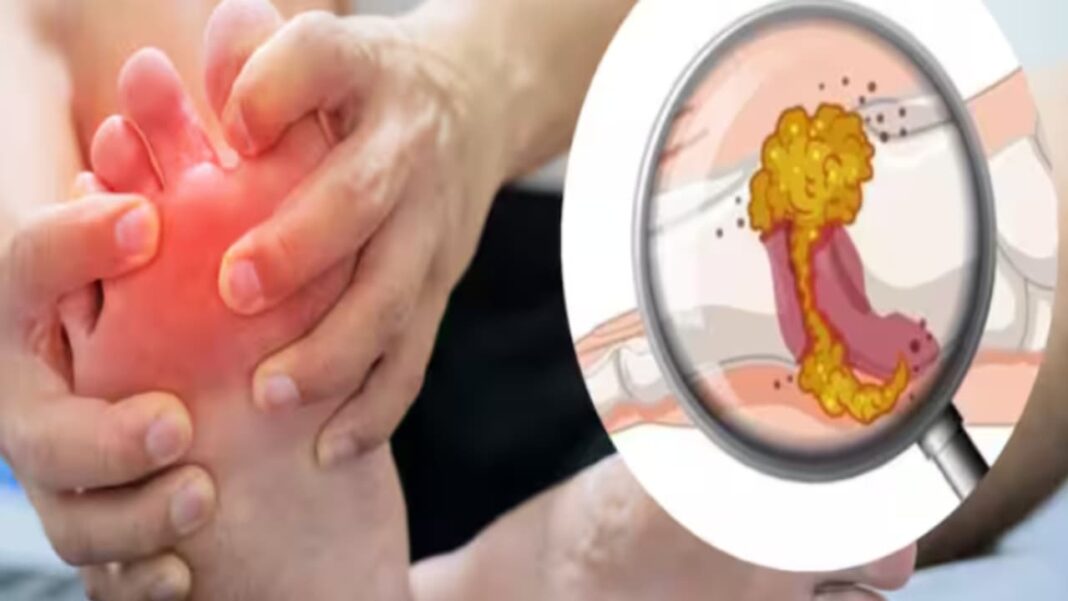 प्यूरीन से भरे फूड खाने पर यूरिक एसिड का लेवल बढ़ता है।
