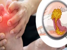 प्यूरीन से भरे फूड खाने पर यूरिक एसिड का लेवल बढ़ता है।