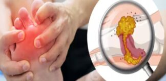 प्यूरीन से भरे फूड खाने पर यूरिक एसिड का लेवल बढ़ता है।